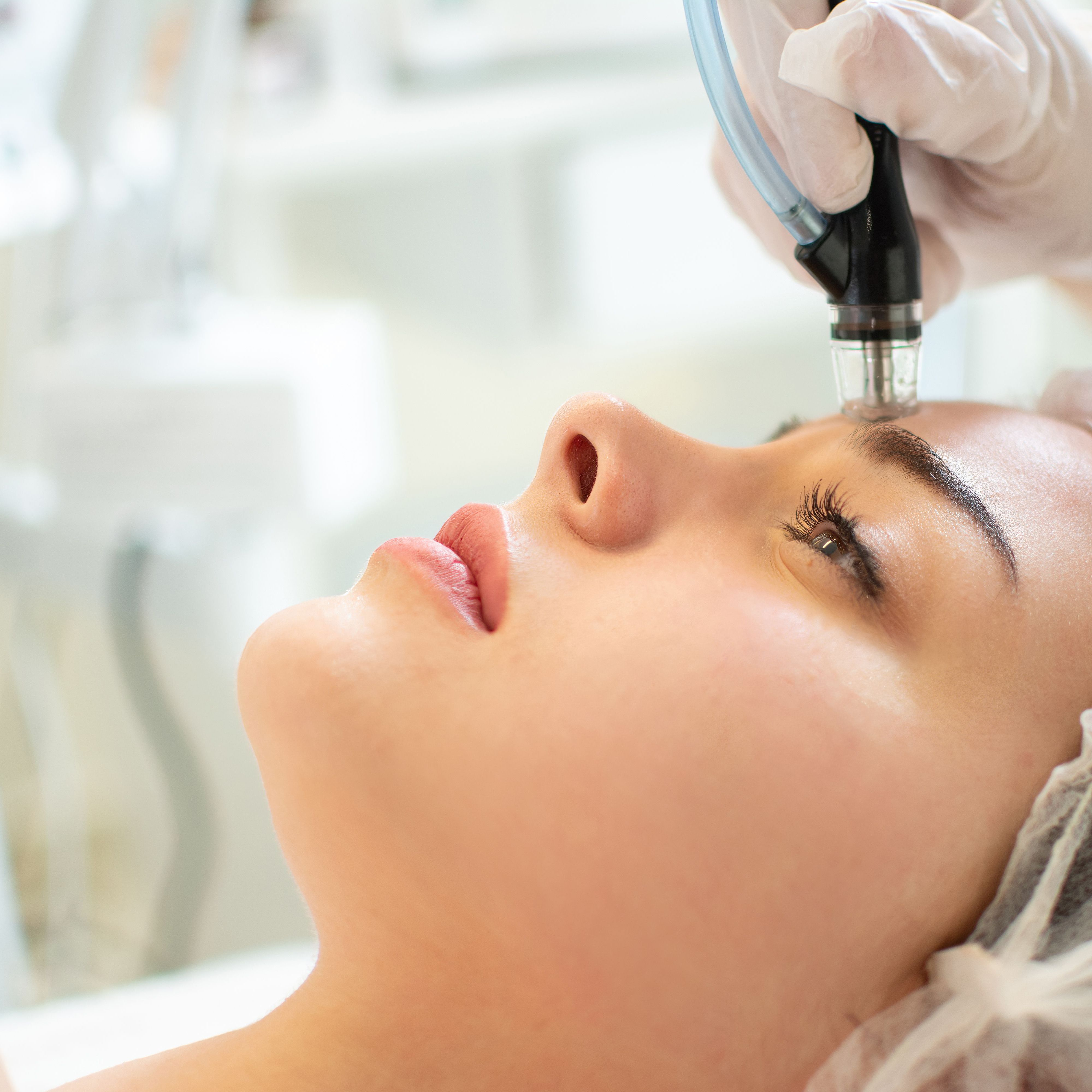 Microneedling – pacchetto da 10 sedute (viso/corpo)